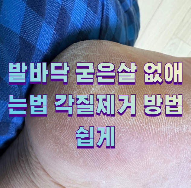 발바닥 굳은살 없애는법 각질제거 방법 쉽게1