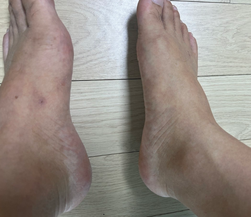 발크기 짝짝이 줄이는법1